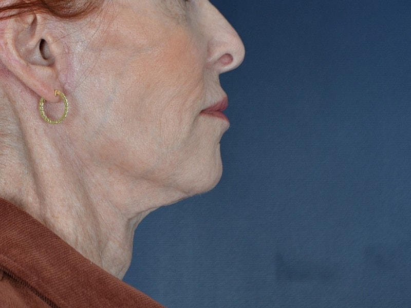 Neck Lift Before & After