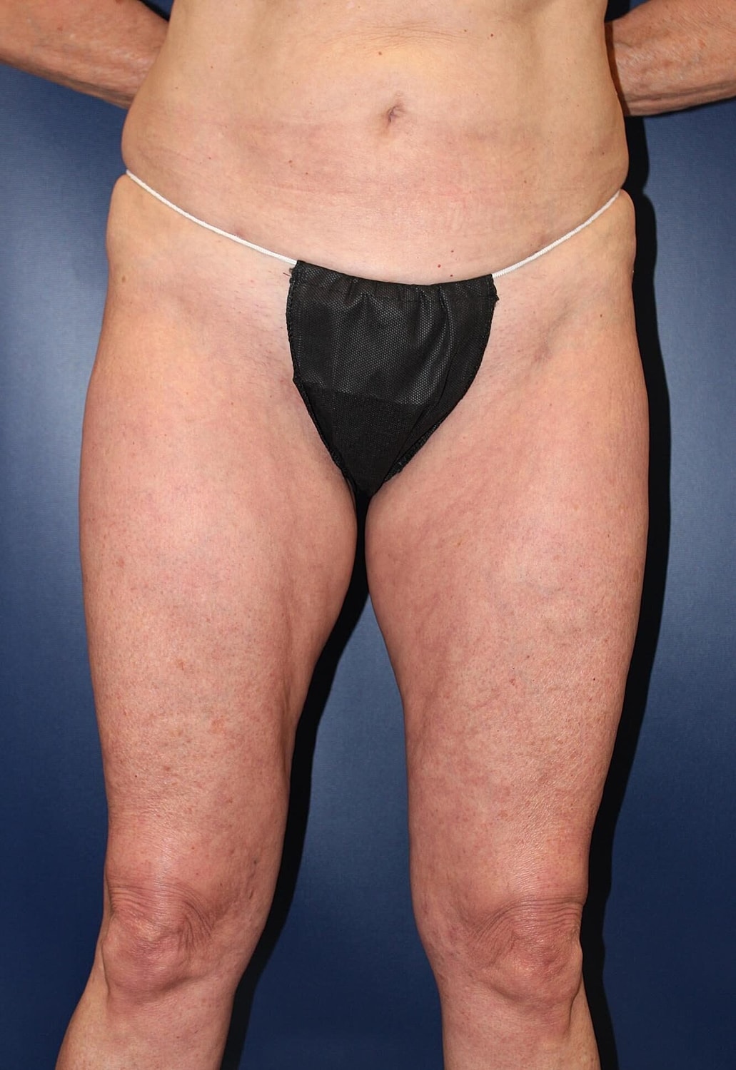 Lower Body Lift Before & After