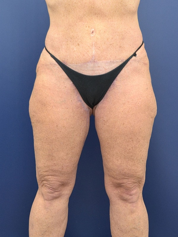 Lower Body Lift Before & After