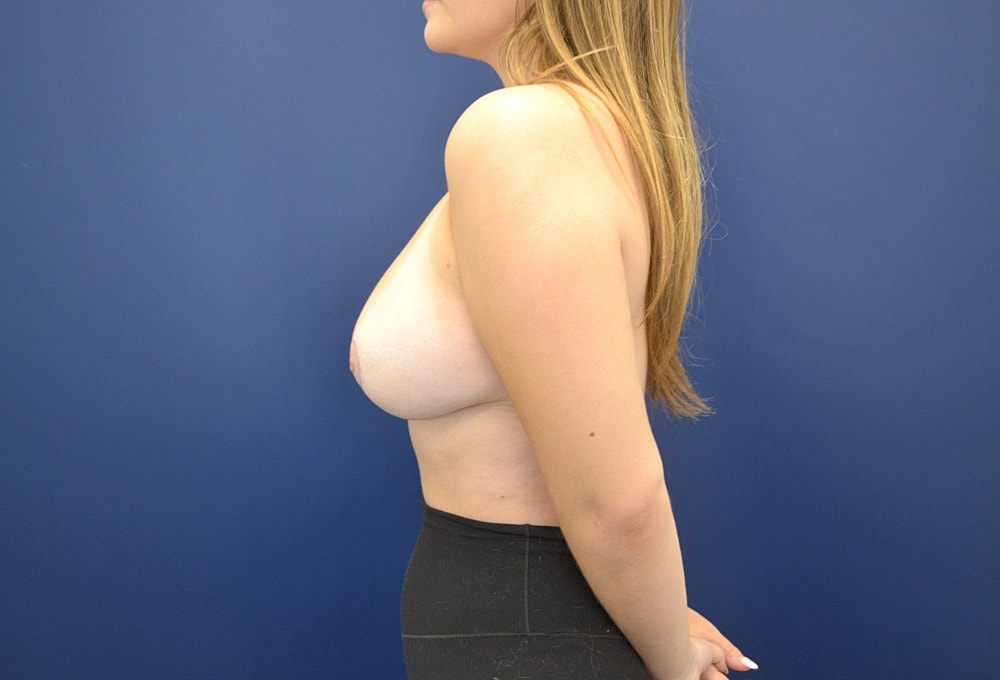 Breast Reduction Before & After