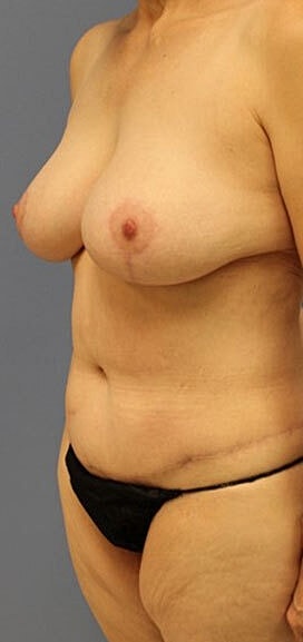 Mommy Makeover Before & After