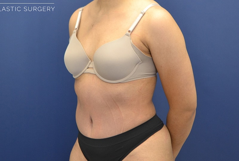 Mommy Makeover Before & After