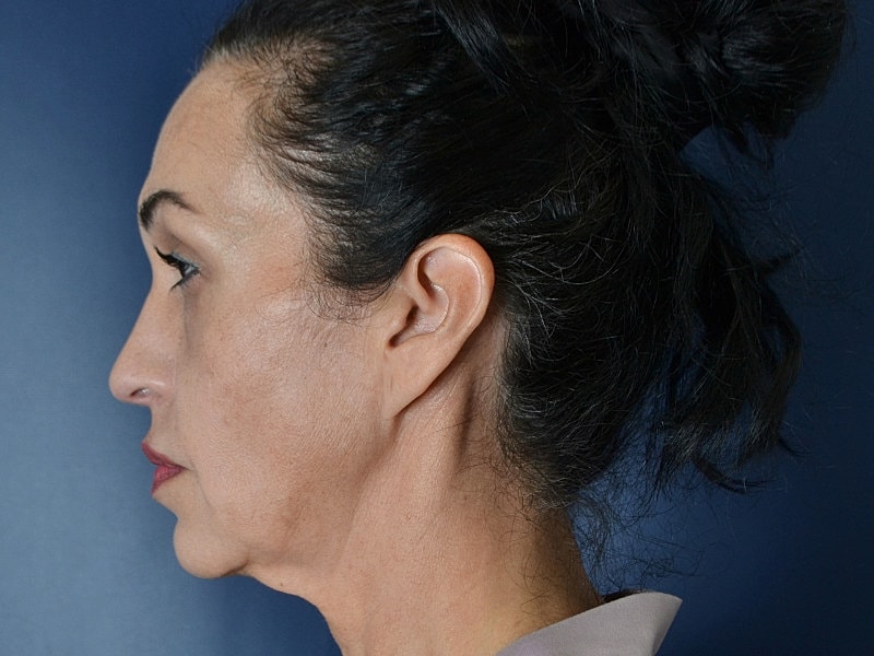 Facelift Before & After