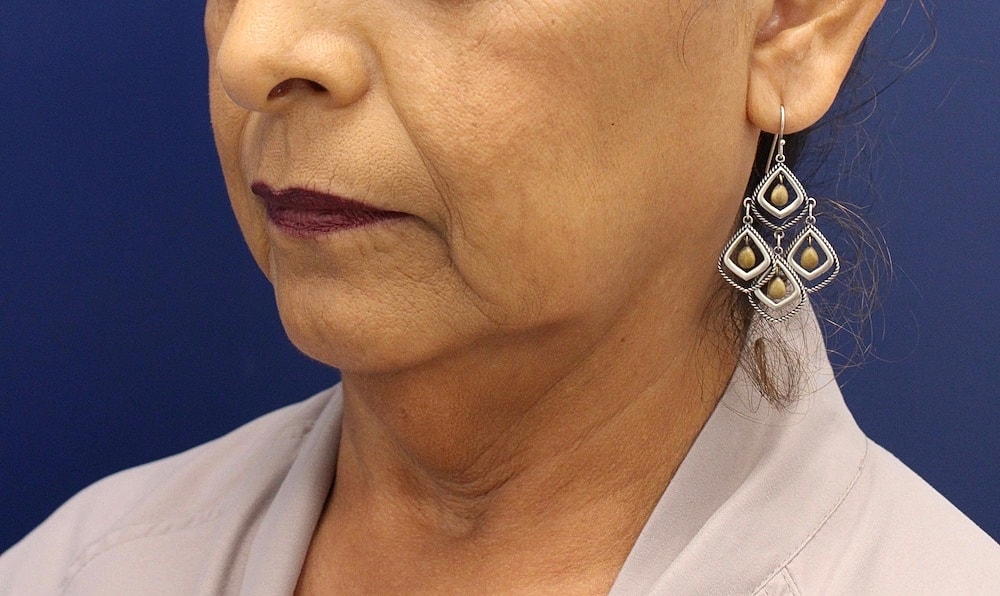 Facelift Before & After