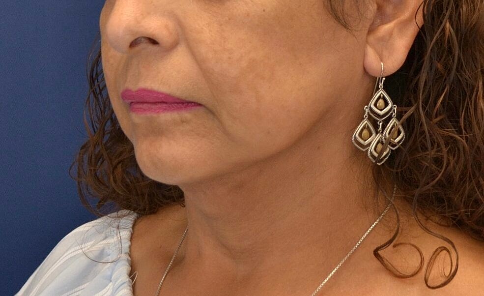 Facelift Before & After