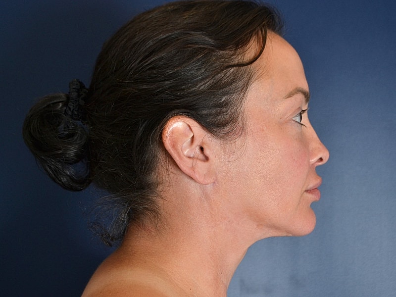 Facelift Before & After