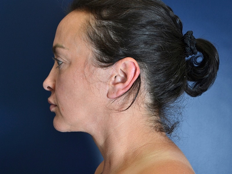 Facelift Before & After