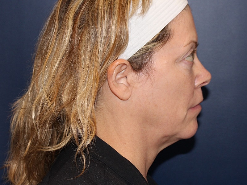 Facelift Before & After