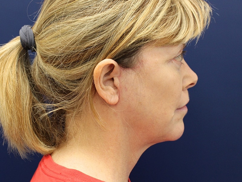 Facelift Before & After
