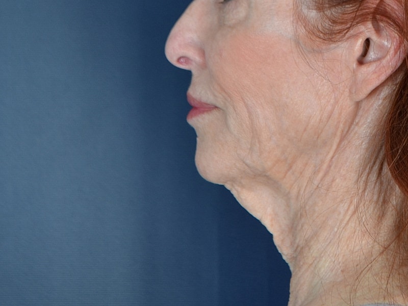 Facelift Before & After