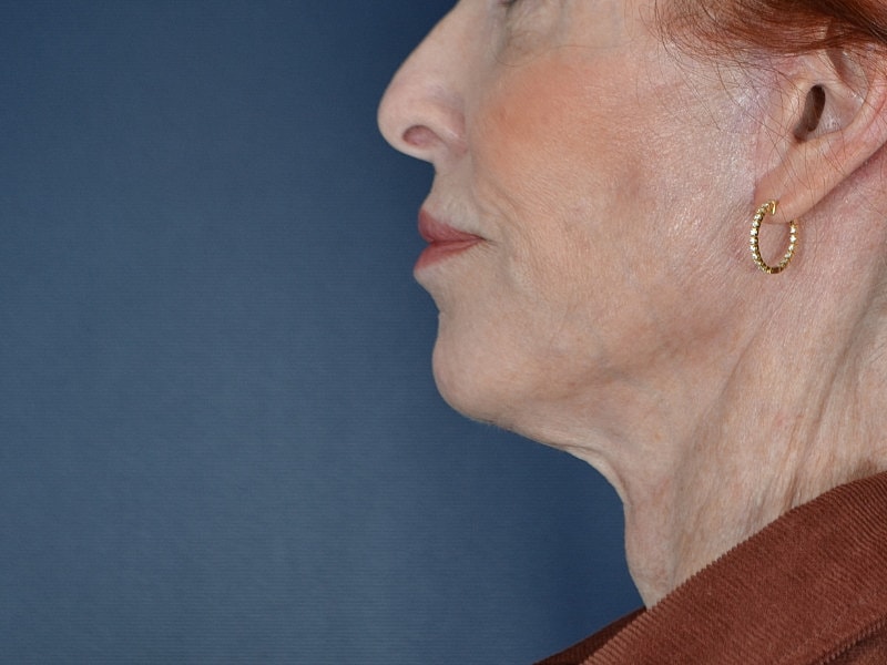 Facelift Before & After