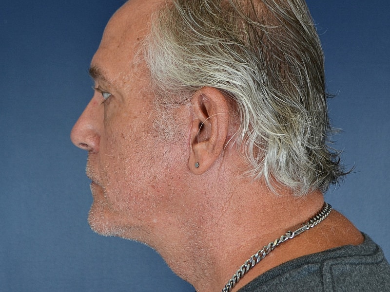 Facelift Before & After