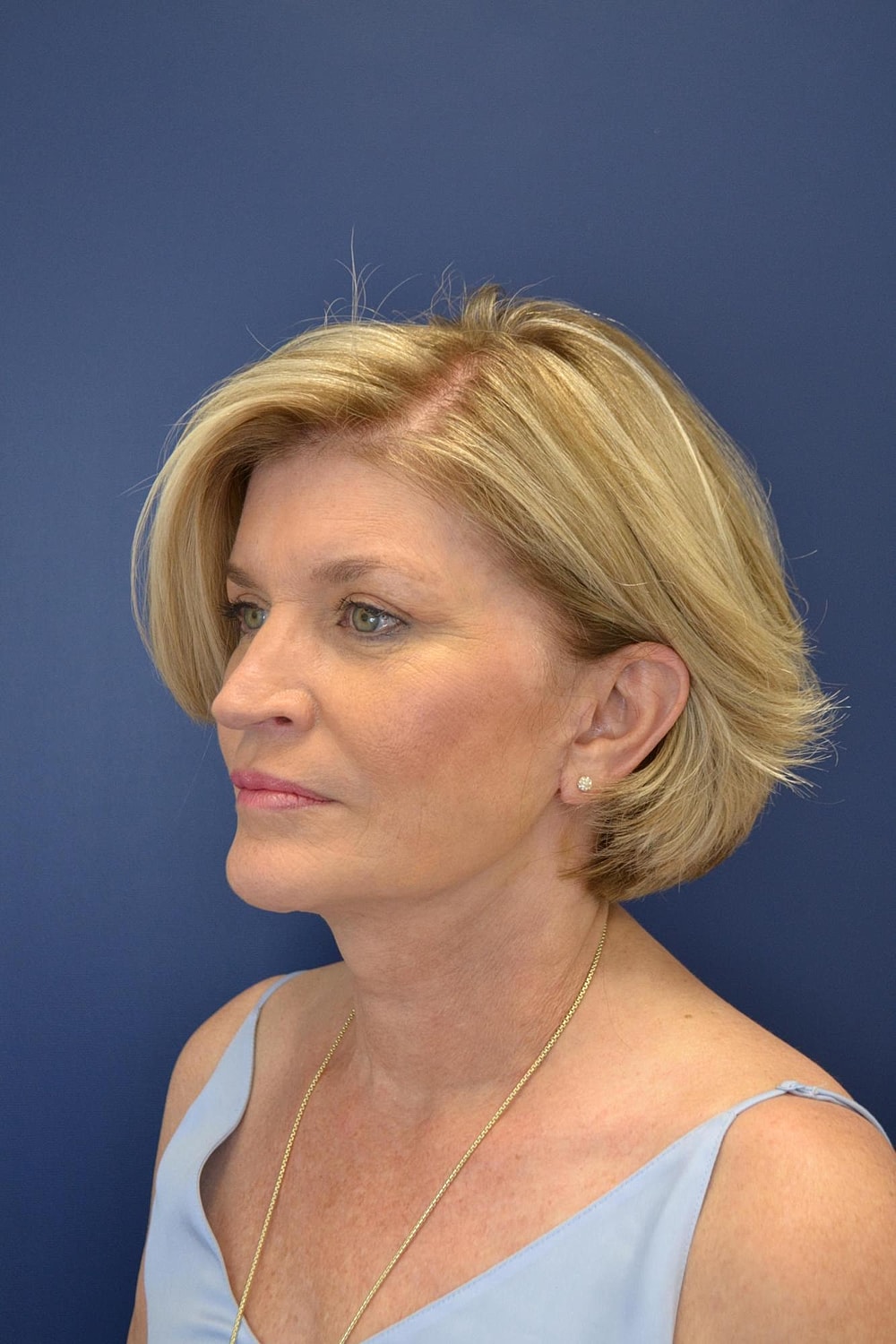 Eyelid Surgery Before & After
