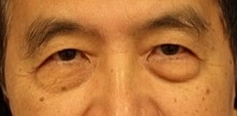Eyelid Surgery Before & After