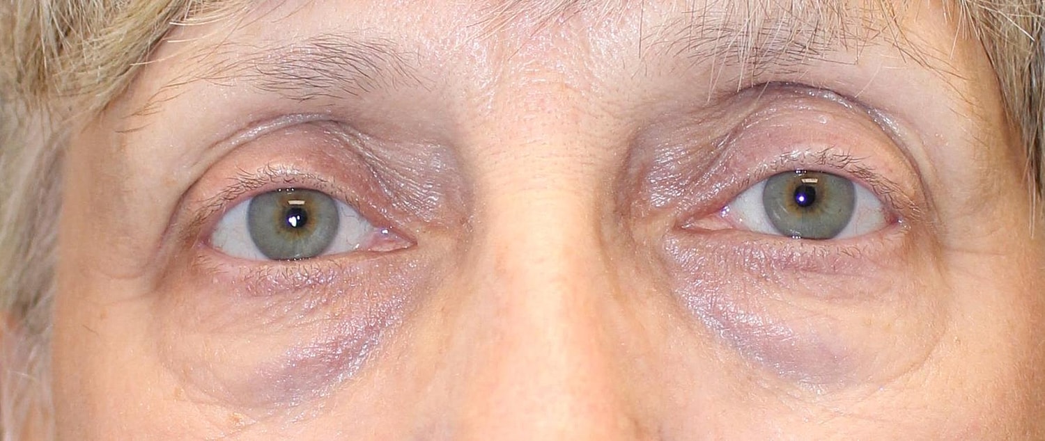 Eyelid Surgery Before & After