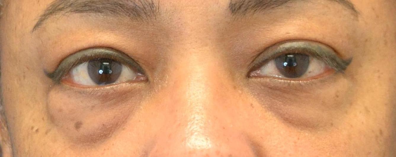 Eyelid Surgery Before & After