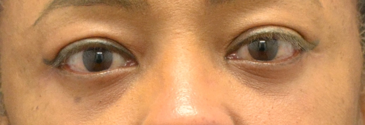 Eyelid Surgery Before & After