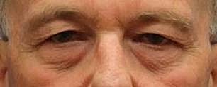 Eyelid Surgery Before & After