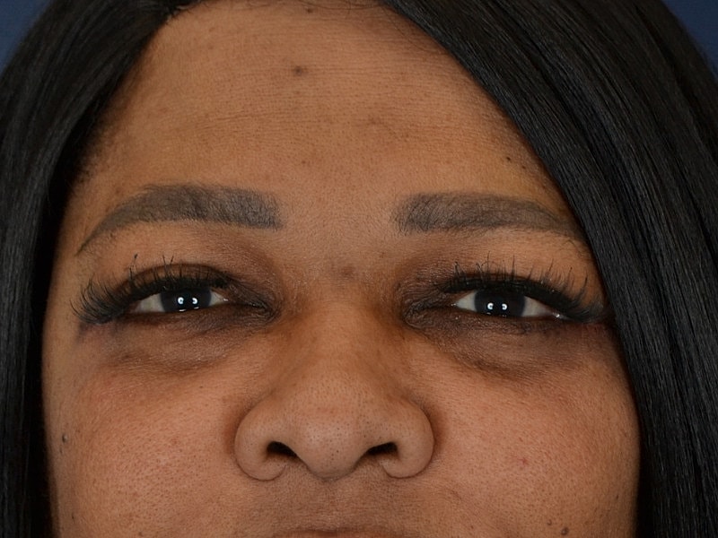 Eyelid Surgery Before & After
