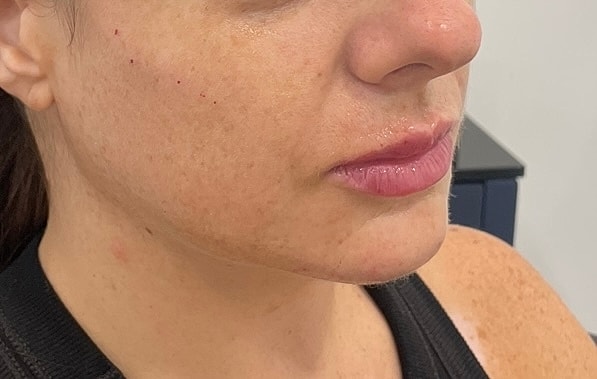Dermal Fillers Before & After