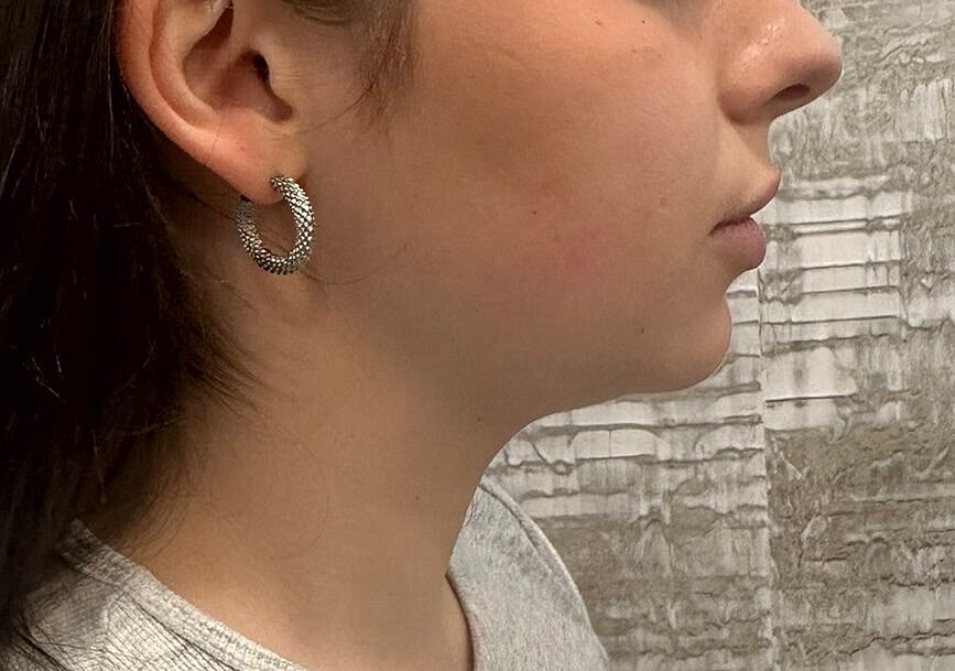 Dermal Fillers Before & After