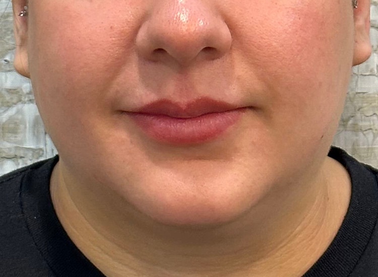 Dermal Fillers Before & After