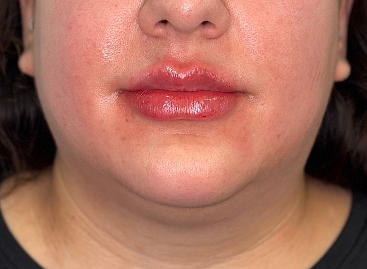 Dermal Fillers Before & After