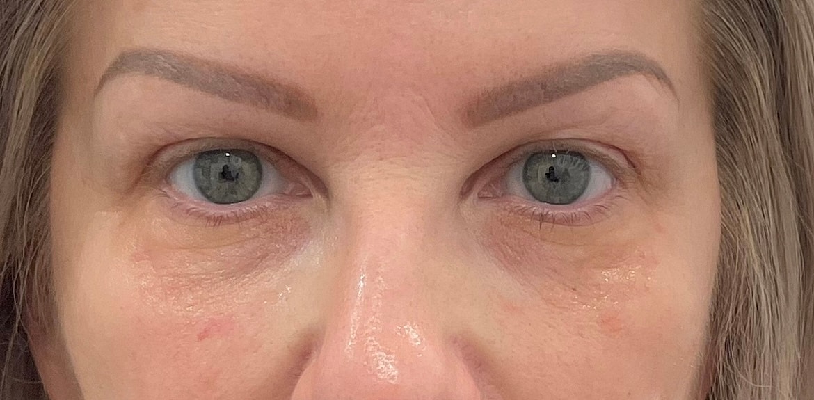Dermal Fillers Before & After