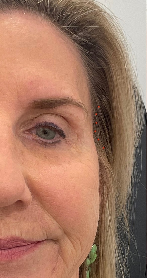 Dermal Fillers Before & After